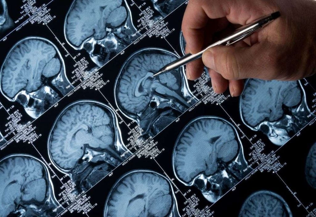 Artificial Intelligence Tool Predicts Alzheimer's With 82% Accuracy